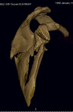 Complex Scapular Fracture CT 1